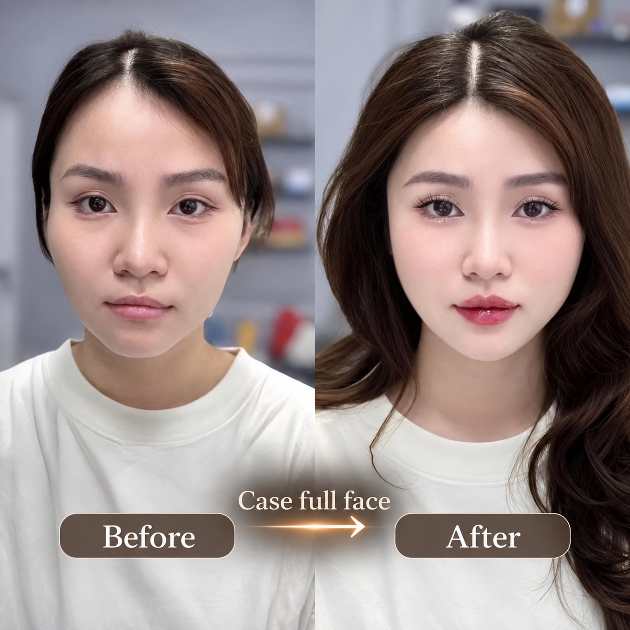 Đã Căng Chỉ Hoặc Tiêm Filler/Botox Có Phẫu Thuật Căng Da Mặt Được Không?