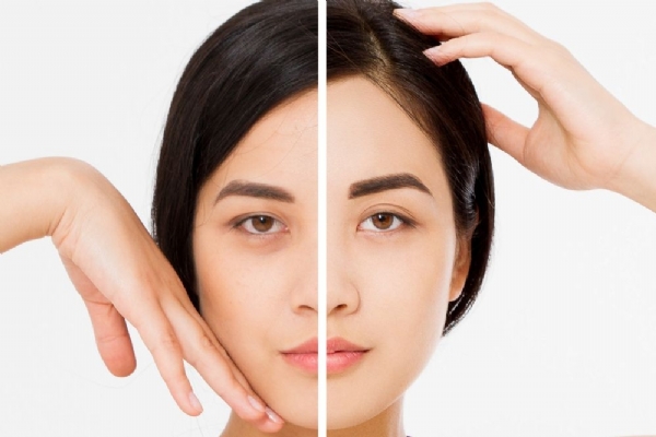 Nâng Cung Mày Bao Lâu Thì Hồi Phục? Có Để Lại Sẹo Không?