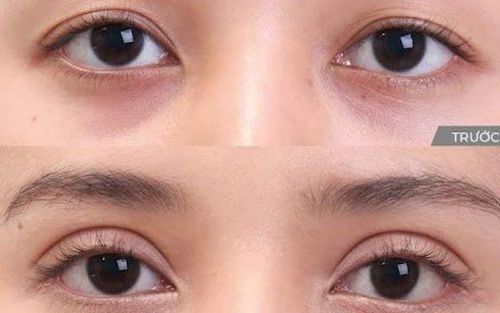 Nhấn mí và cắt mí đều giúp cho đôi mắt trở nên to tròn