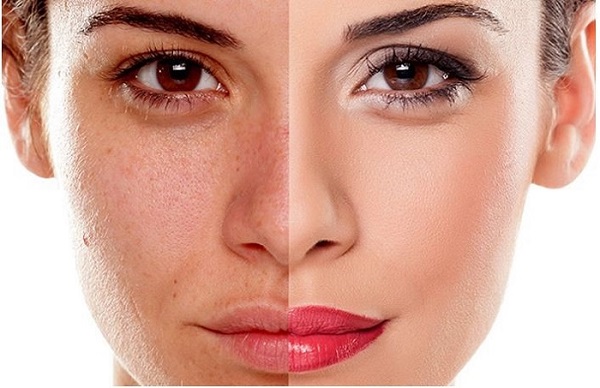 Nám da còn là một biểu hiện của quá trình lão hóa da tự nhiên
