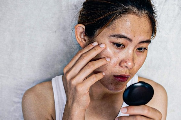 Căng thẳng kéo dài có thể làm rối loạn nội tiết tố, kích thích tăng sắc tố khiến da bị nám