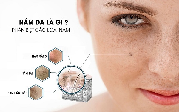 Nám da có 3 tình trạng phổ biến với mức độ dễ điều trị không giống nhau
