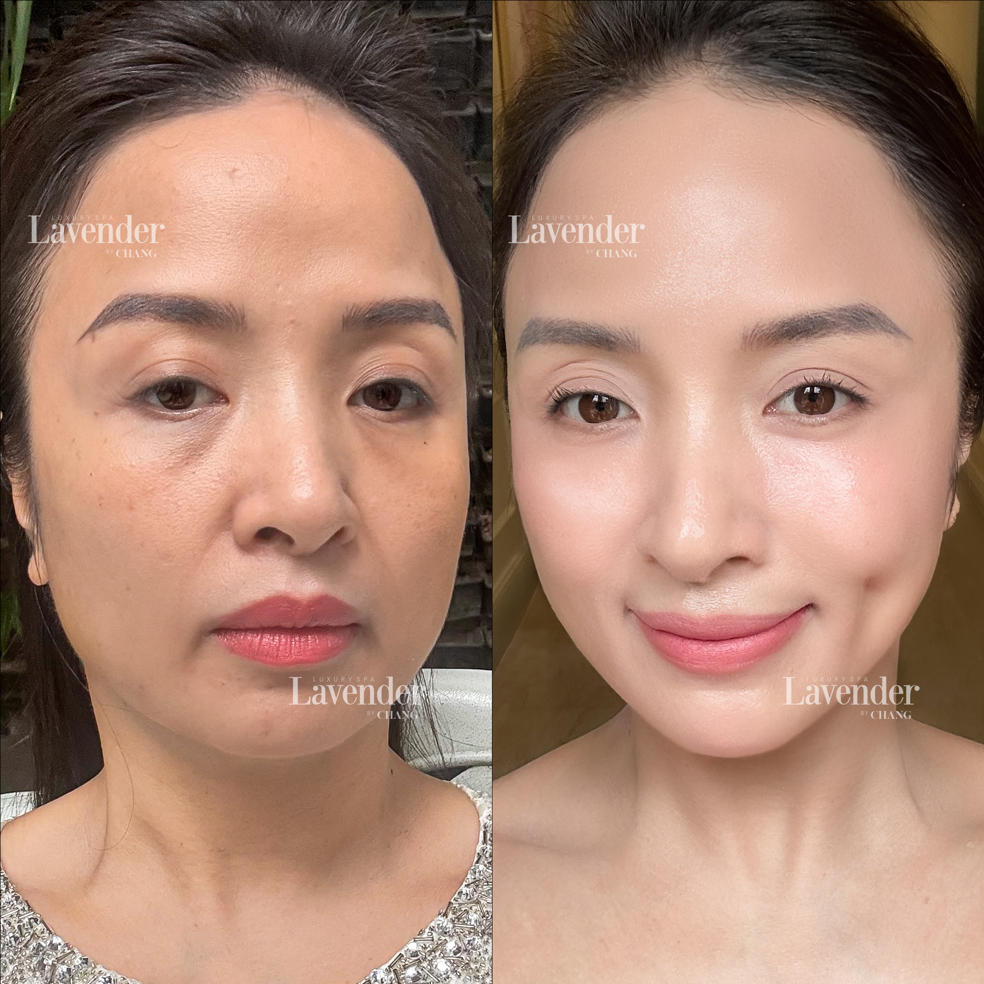 thermage pico pro 5 - lavender by chang